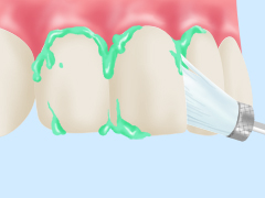 歯のクリーニング（PMTC：　Professional Mechanical Tooth Cleaning）