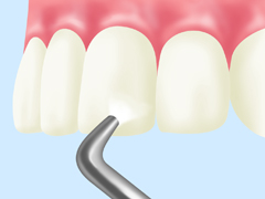 歯のクリーニング（PMTC：　Professional Mechanical Tooth Cleaning）